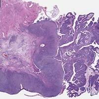 Gynecologic Pathology Sample 3